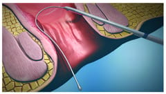 Fixcision - A Fistula Coring Device