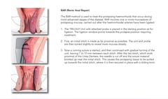 HAL - RAR-trilogi (Doppler-styret arterieligation for hæmorider)