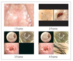 Rectale camera - Dr Camscope Pro LED-videoproctoscoop